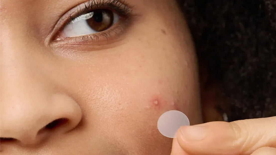 Do Acne Patches Actually Work? Here's What the Science Says