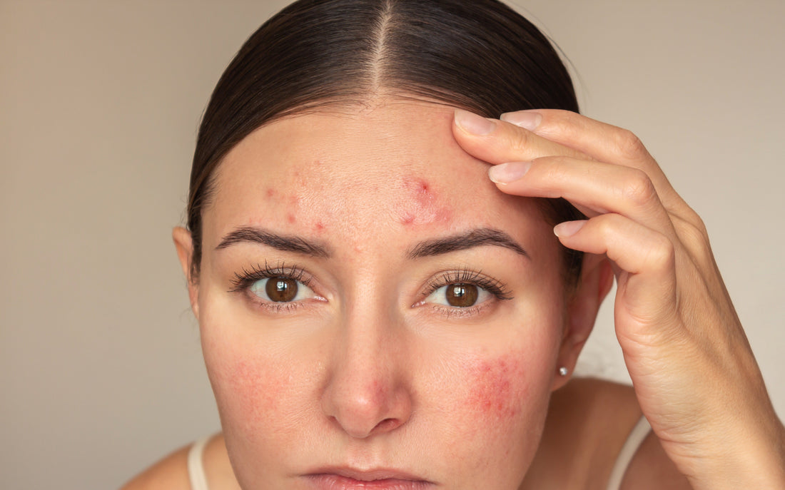 Can Pimple Patches Make Acne Worse? The Honest Answer