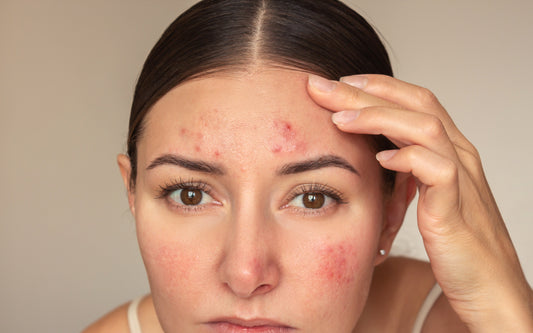 Can Pimple Patches Make Acne Worse? The Honest Answer