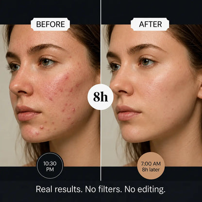 Patchly Overnight Acne Patches